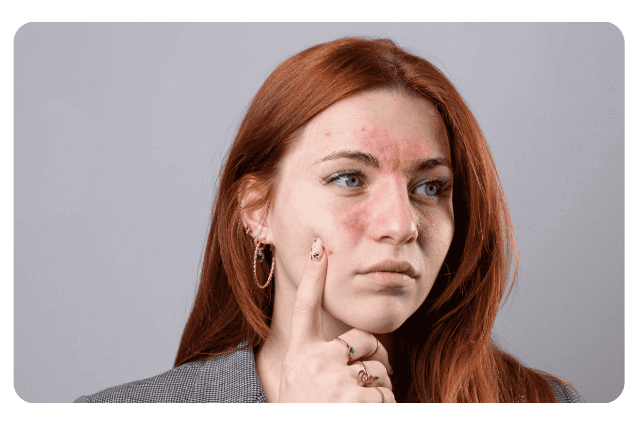 Traitement de la rosacée : Guide complet des solutions efficaces