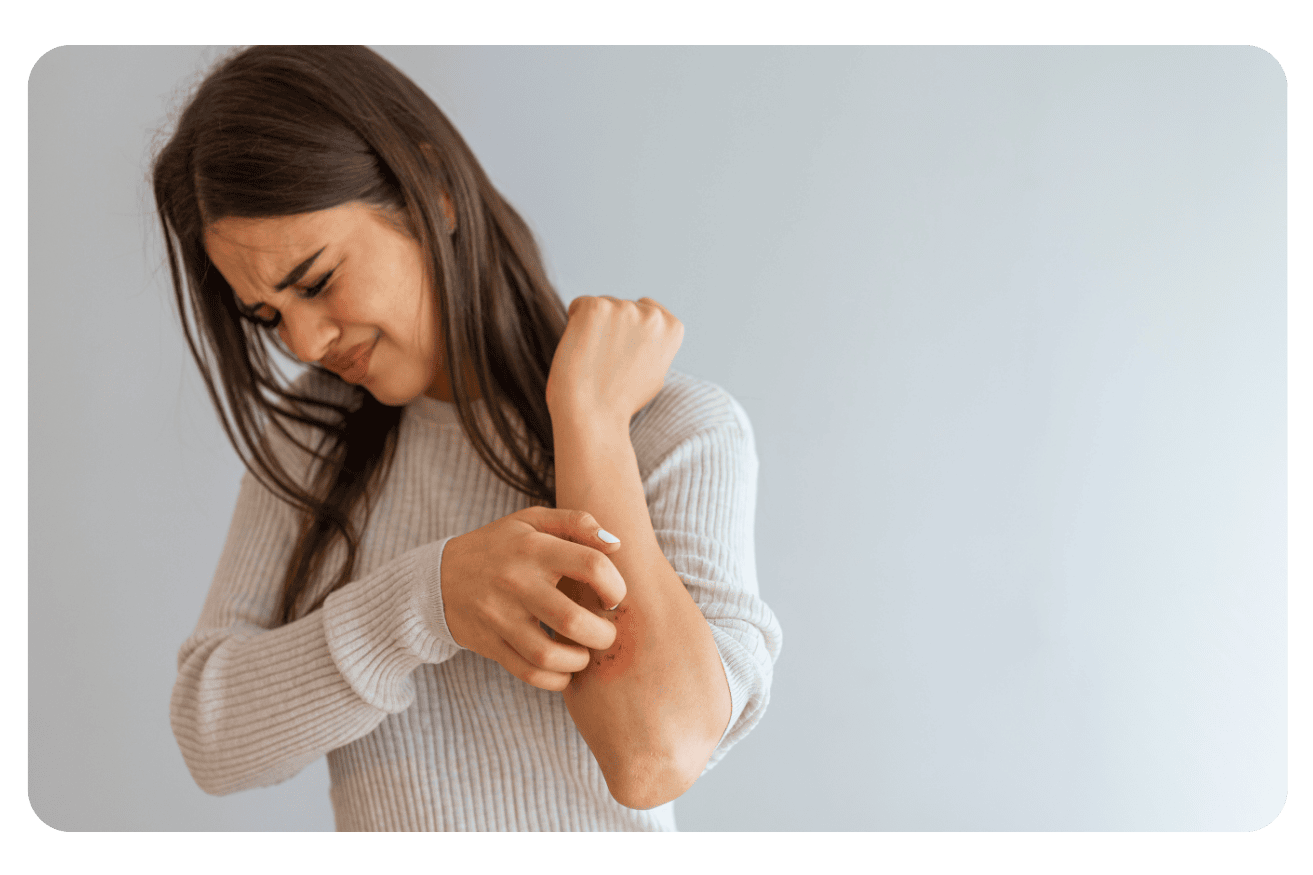 Eczéma : Traitements Efficaces et Solutions Naturelles pour Soulager les Symptômes