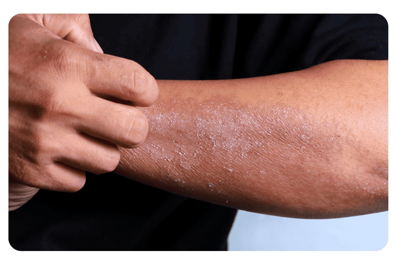 Maladies auto-immunes de la peau : Symptômes, diagnostic et traitements