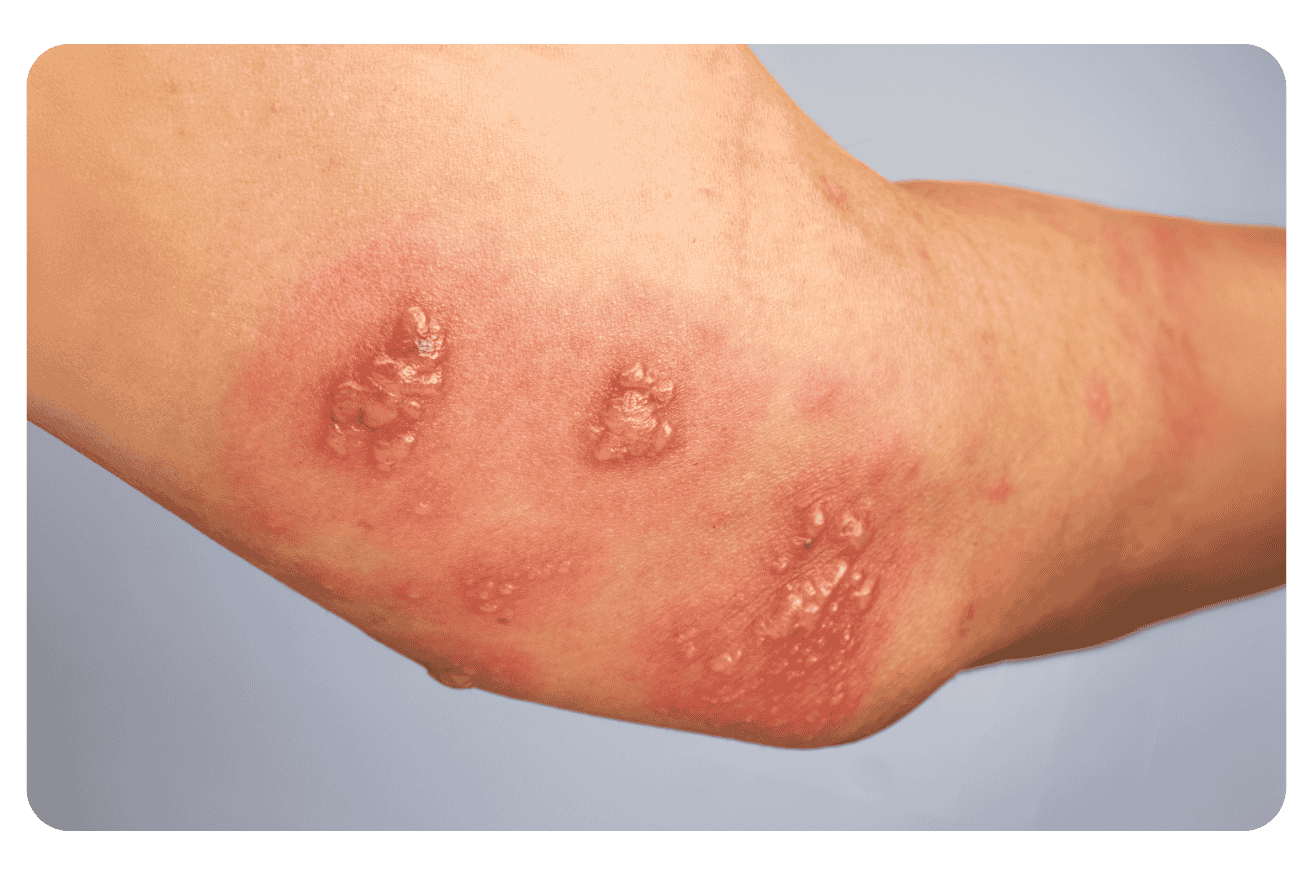Maladie de Verneuil : définition, symptômes et diagnostic