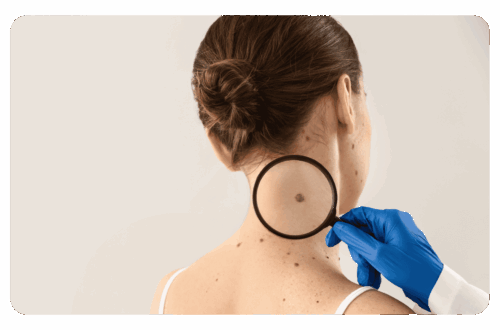 un grain de beauté peut-être un mélanome