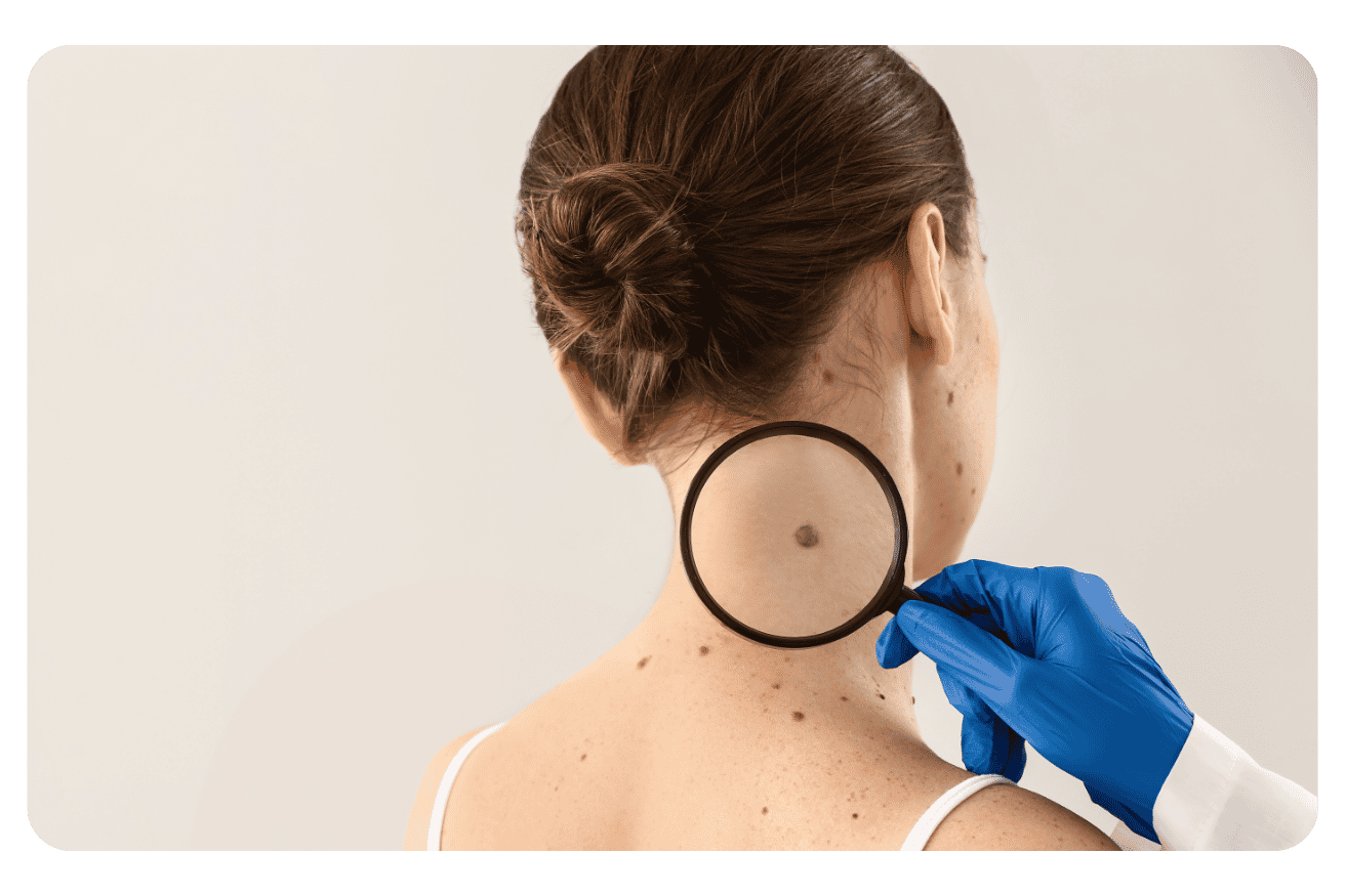 Cancers de la peau : prévention et dépistage du mélanome