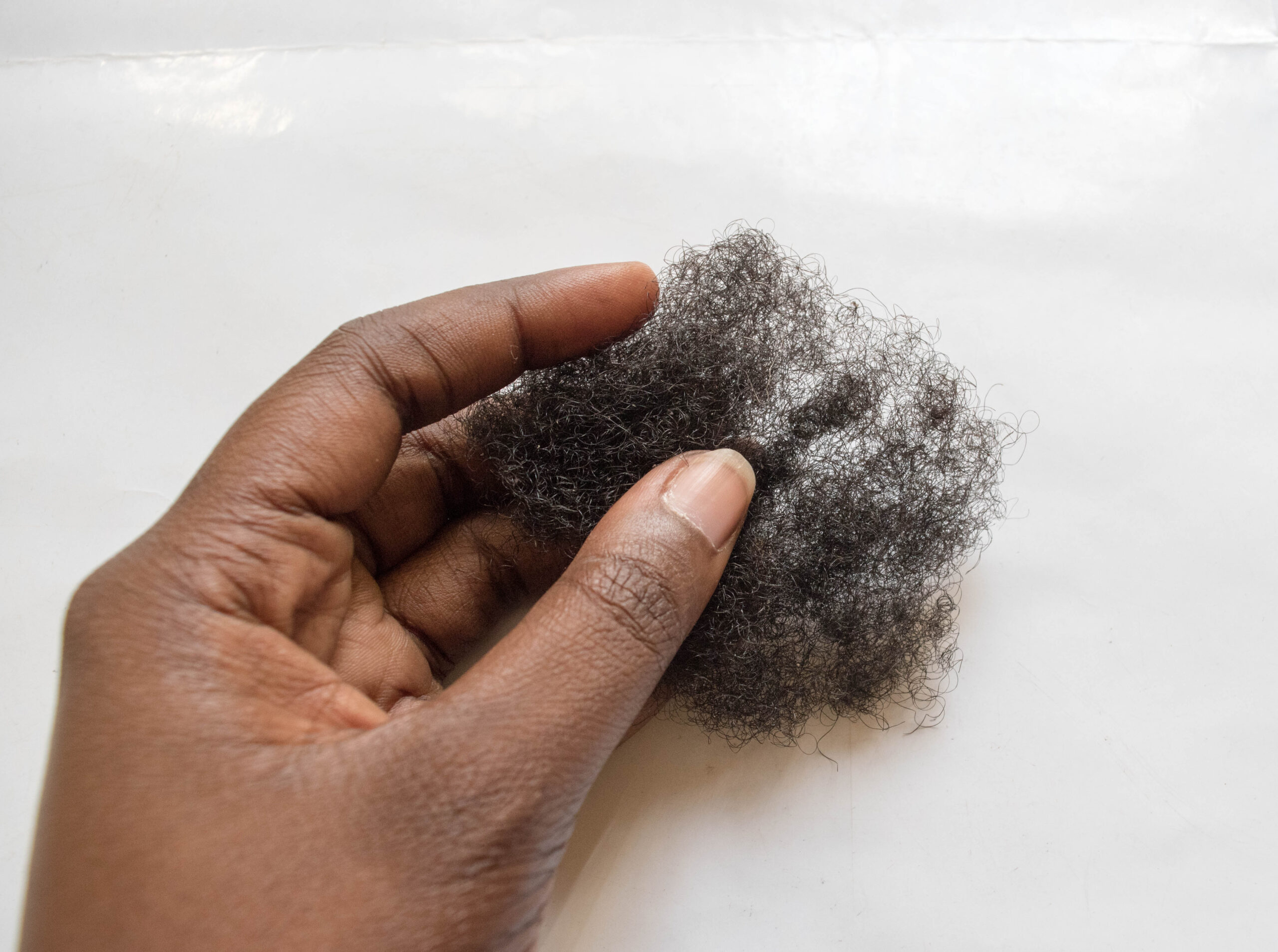 Autoimmune Disease; A Major Cause Of Hair Loss