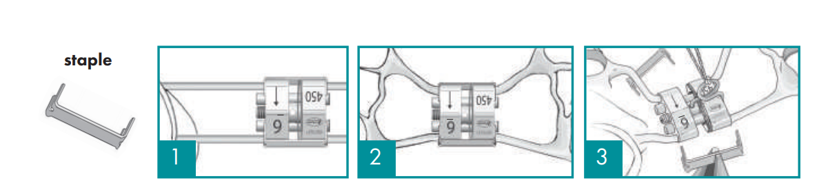 Leone Memoria Leaf Spring Activated Expander | DentaCarts | Dental Cart