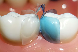 Bioclear Posterior Matrix System | DentaCarts | Dental Cart