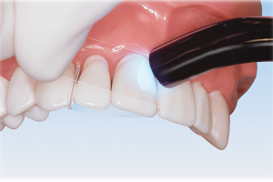 Premier Stop Strip Matrix Bands (100 pcs) | DentaCarts | Dental Cart