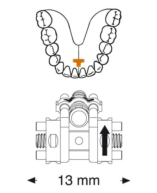 Leone 3 Directional Screw For Lower Arch 13mm (3 Way) | DentaCarts | Dental Cart