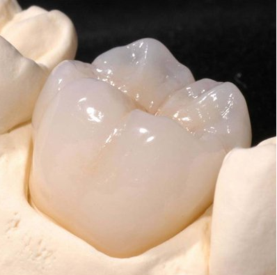 STL DENTAL SOLUTION ( DENTAL LAB) ( IMPLANTS  SINGLE ) | DentaCarts | Dental Cart