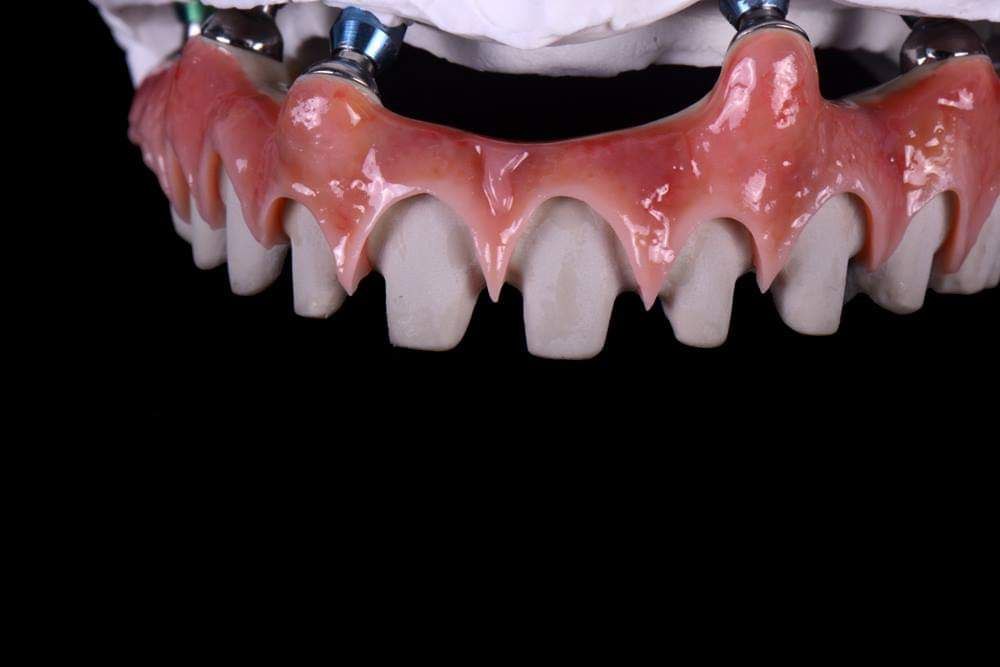 STL DENTAL SOLUTION ( DENTAL LAB) ( IMPLANTS Full Arch )