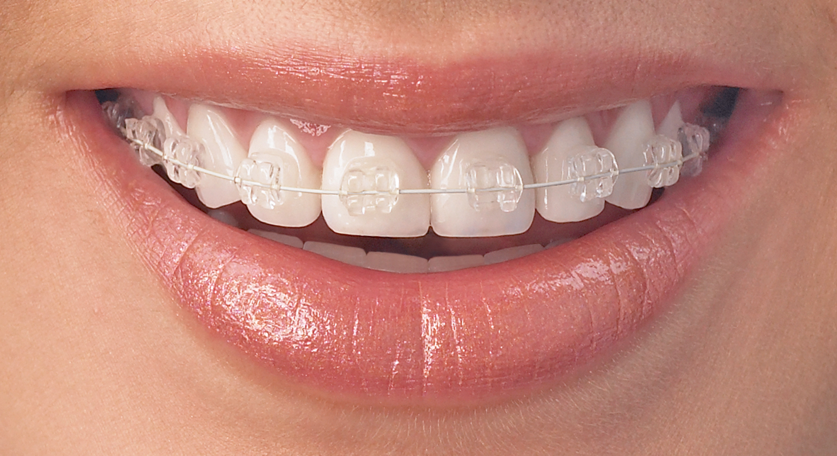 Radiance Plus Clear Brackets Roth 022 ref | DentaCarts | Dental Cart