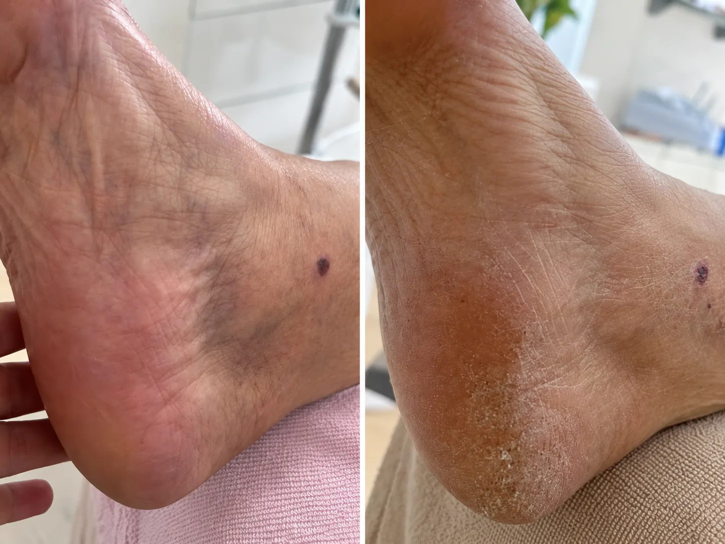 Tratamento Intensivo para os Pés
