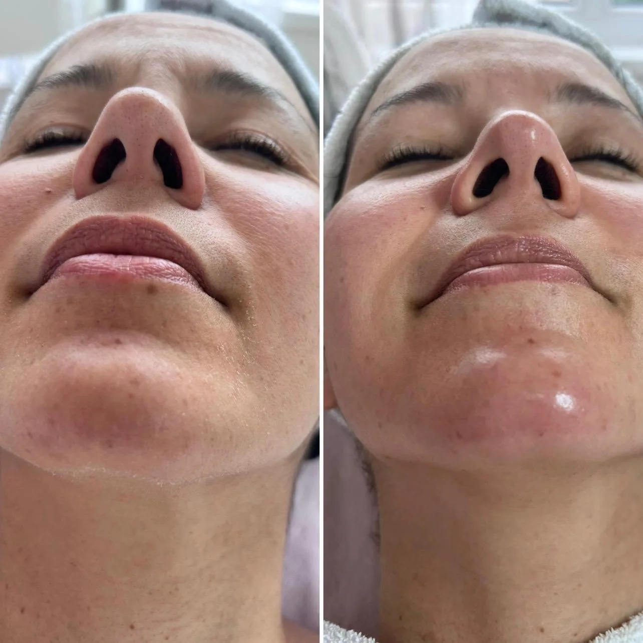 Limpeza pele Profunda e Microdermabrasion