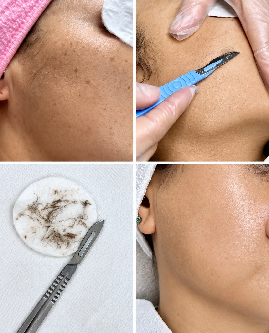 Dermaplaning
