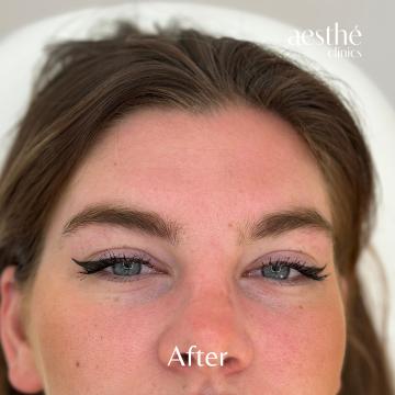 botox voorhoofd after