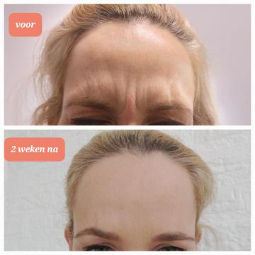 Fronsrimpels voor/na van Skin Esteem Nijmegen Voor Botox en Fillers (na)