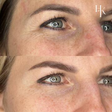 Botox - kraaienpootjes (V staat op site, staat op sm)