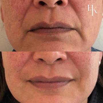 Fillers (staat sitestaat story)