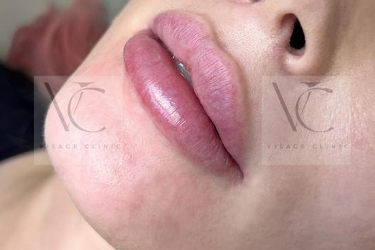 Fillers door Onur Kenc