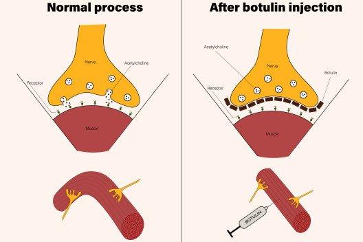 Wie funktioniert Botox?