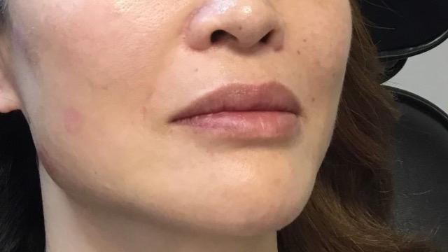 Neus-lippenplooi voor/na van MyInjectables Clinics Velp (na)