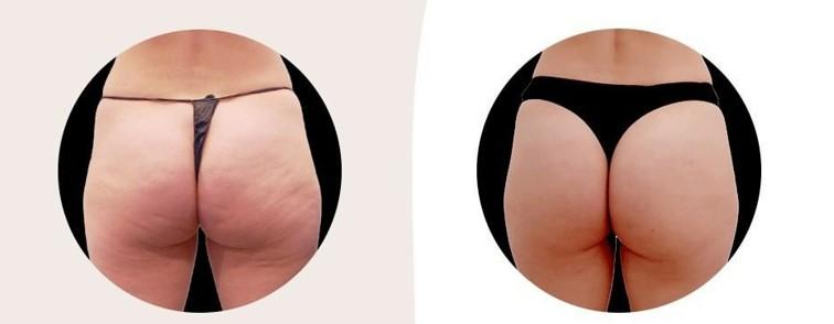 Cellulite am Gesäß entfernen