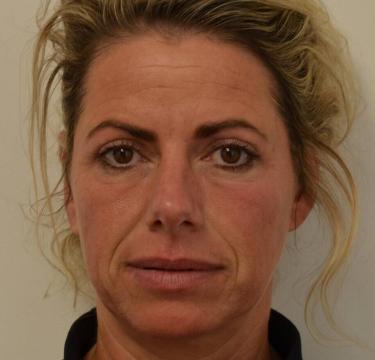 3 Liquid Facelift voor en na