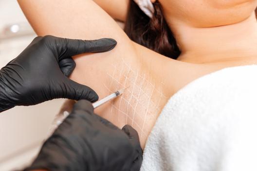 Was kostet eine Botox-Behandlung gegen Schwitzen?