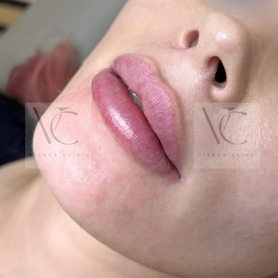 Alles, was Sie über Lippenfüller wissen müssen – Meine Erfahrungen und Ratschläge