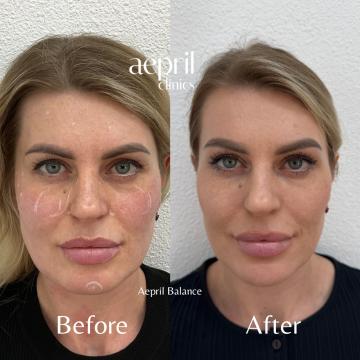 Before - 15