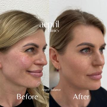 Before - 17