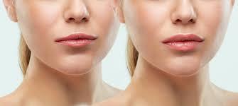 Lipfiller3
