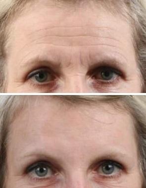 Botox-voorhoofd-voor-en-na