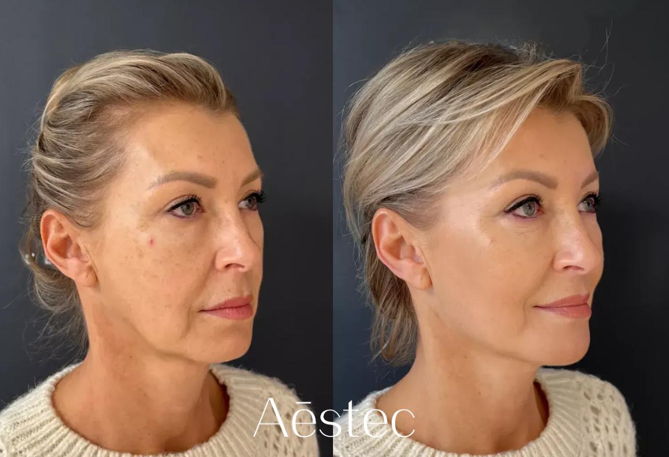 liquid-facelift-voor-en-na