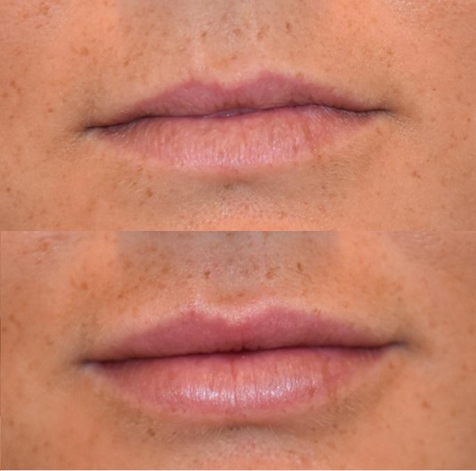 lip-filler-voor-en-na