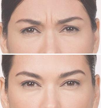Fronsrimpel-botox-voor-en-na