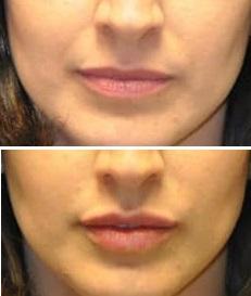 lippen-opvullen-voor-en-na-foto