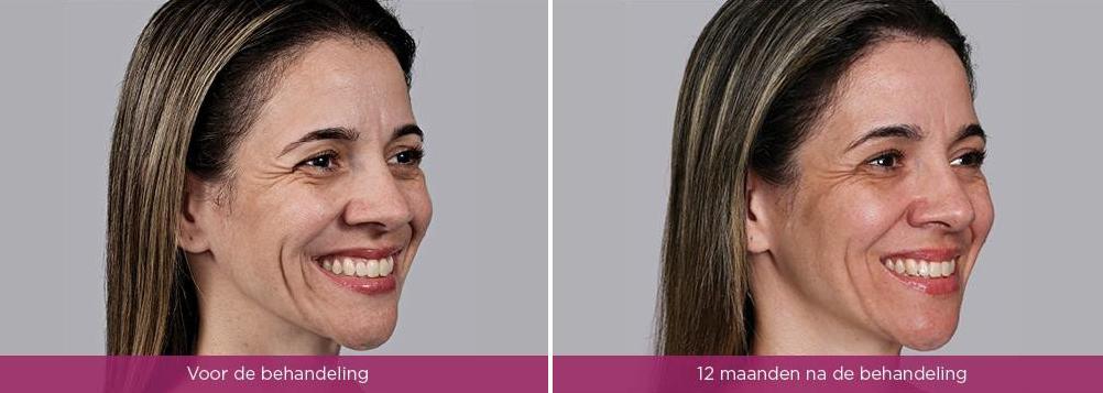 Sculptra-voor-en-na