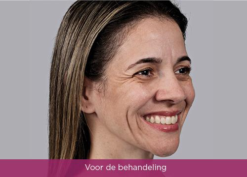 Sculptra-voor-foto