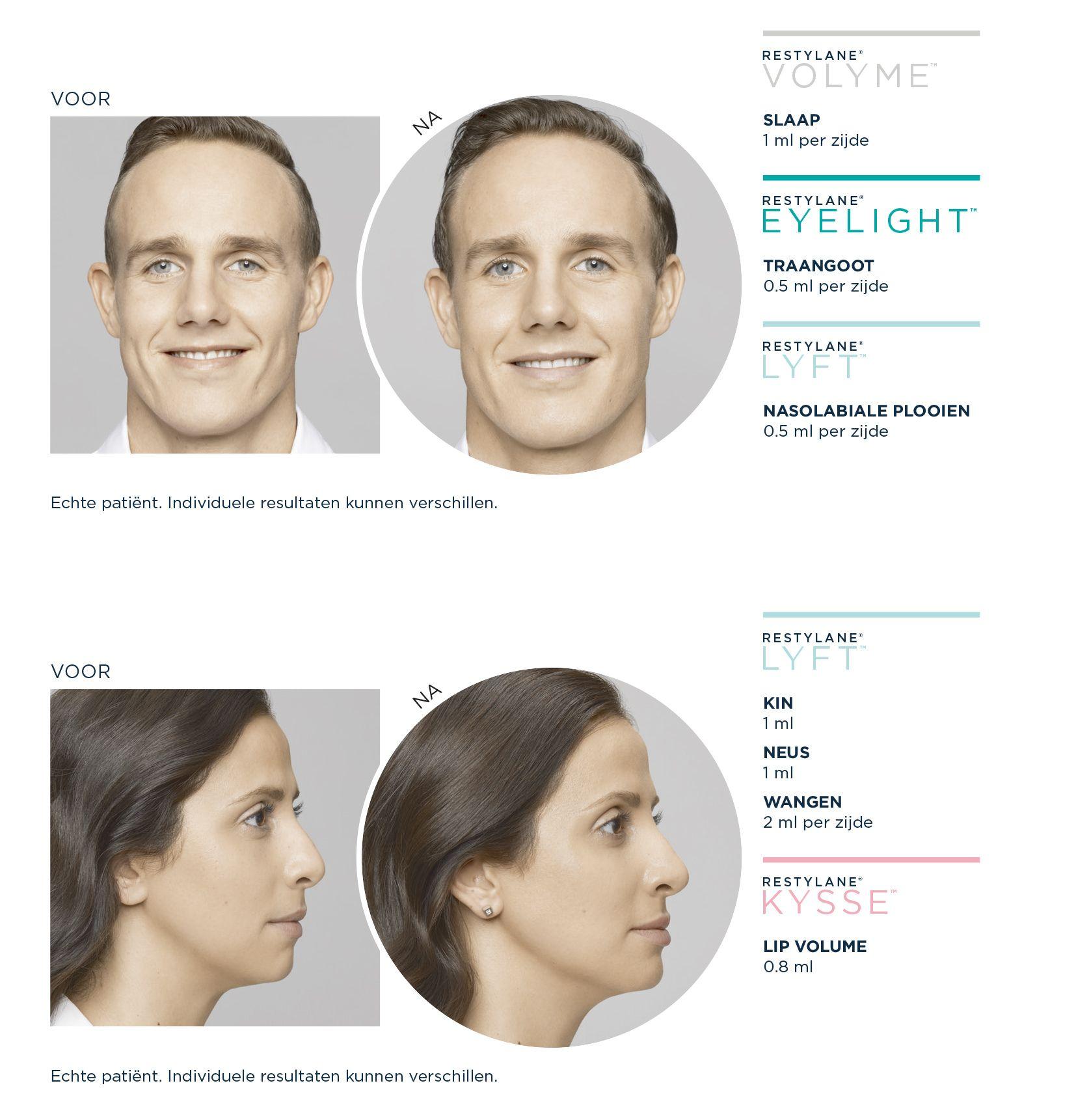 Restylane-Voor-en-Na