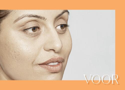 Restylane-Voor-afbeelding
