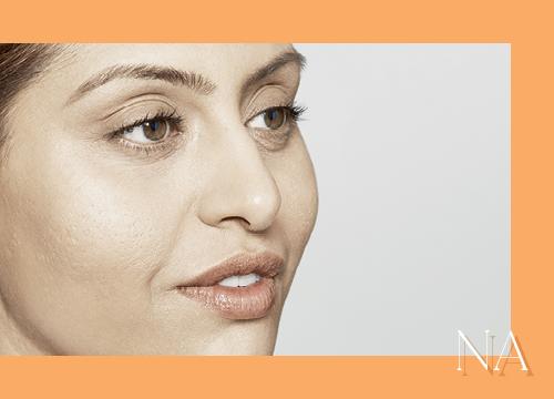 Restylane-voor-en-na-foto