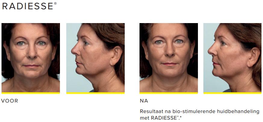 Radiesse-behandeling-voor-en-na