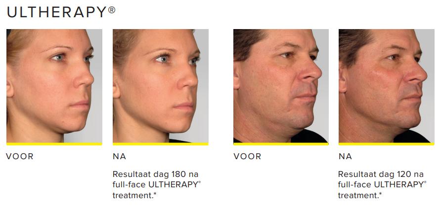 Ultherapy-voor-en-na