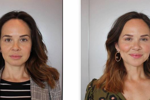 hyaluronzuur-filler-behandeling-card