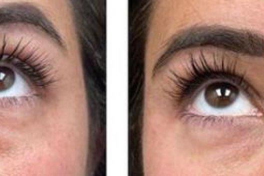 Tear-trough-before-and-after-card