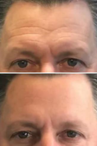 Botox men before and after