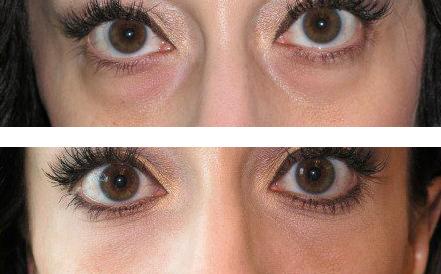 Tear trough filler before and after