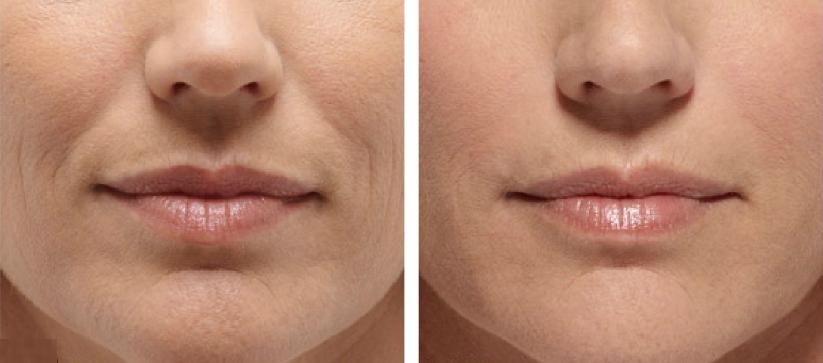 neus-lippenplooi-voor-en-na
