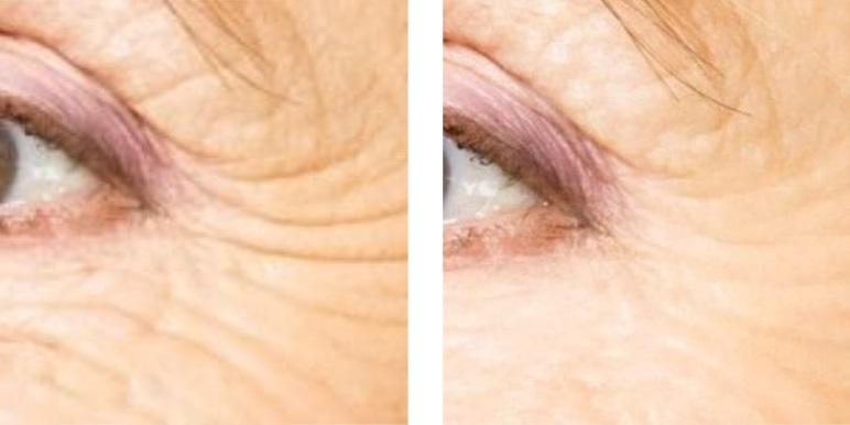 Crow's feet before and after