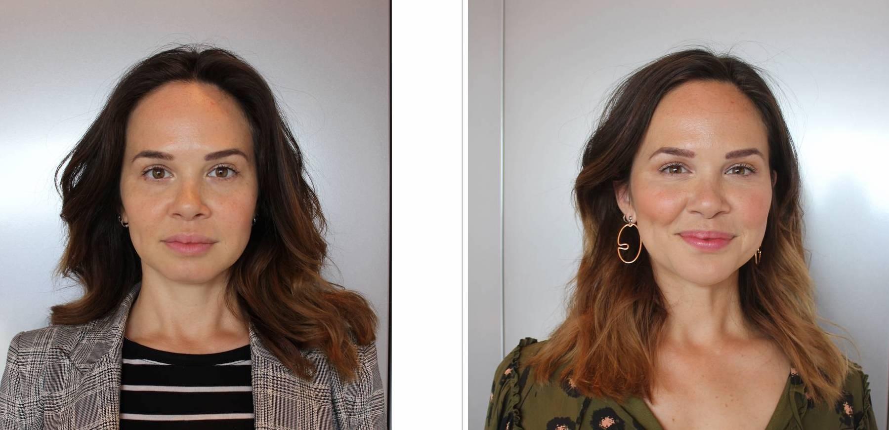 hyaluronic acid filler treatment